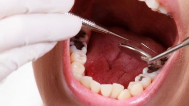 7 cách chữa sâu răng theo bài thuốc dân gian